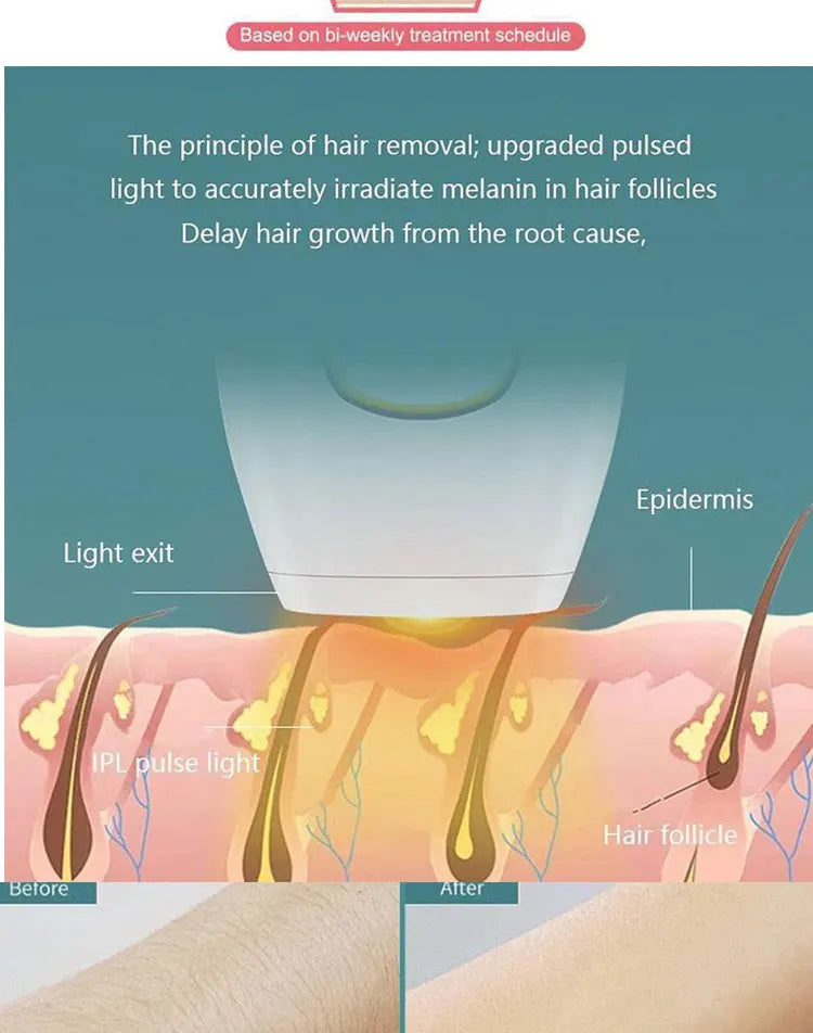 IPL Laser Ontharing - Professioneel Thuisapparaat